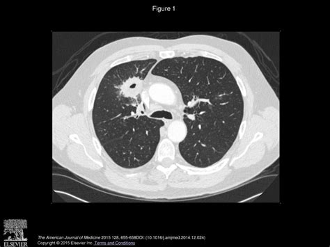 Solitary Lung Masses Due to Occult Aspiration - ppt download