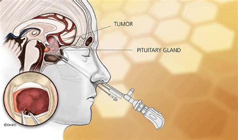 The resilient pituitary gland: What happens when the pituitary gland ...