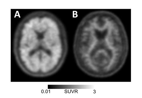 Image of Amyloid PET Scan [IMAGE] | EurekAlert! Science News Releases