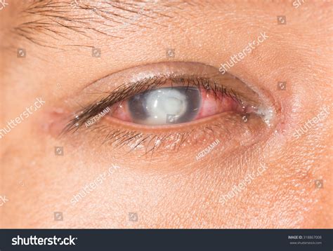 Close Severe Fungal Corneal Ulcer During Stock Photo 318867008 ...