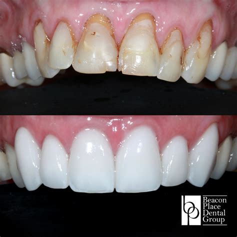 A new smile with porcelain veneers – Artofit