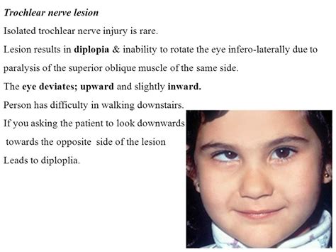 Trochlear Nerve Palsy Eye Position