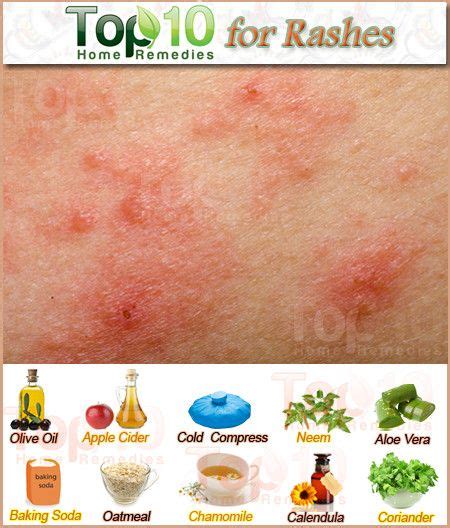 7 Best Heat Rash ideas | heat rash, rashes remedies, heat rash remedy