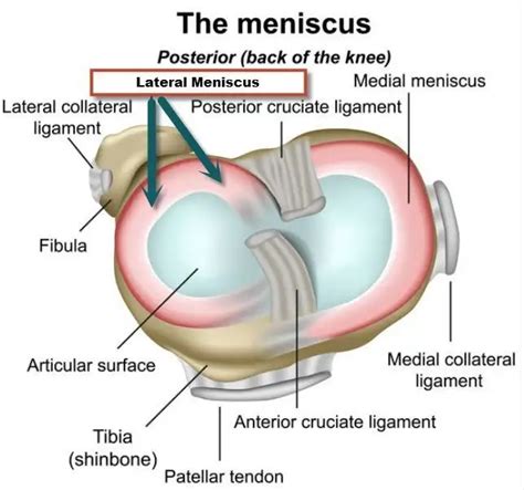 Lateral Meniscal Tear