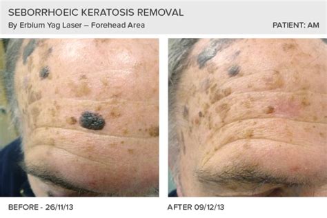 Seborrhoeic Wart Removal Testimonials - Leeds, Bradford, Yorkshire