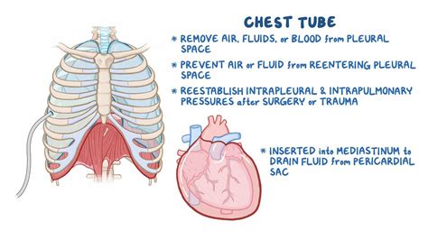 Chest Tube Insertion