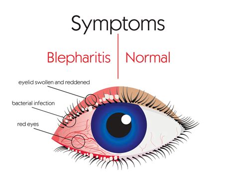 Treating Blepharitis | Eyelids | Eye Doctor in Fort Worth TX