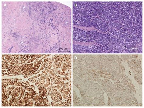 Clinical features, histology, and histogenesis of combined ...