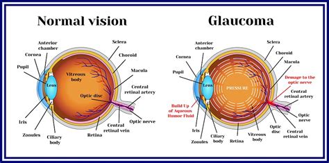 Angle-Closure Glaucoma - Fort Lauderdale Eye Institute