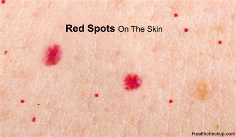 Red Spots On Skin Cancer