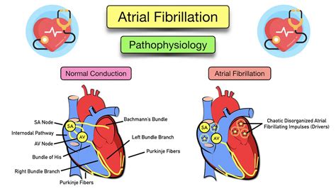 Atrial Fibrillation: Symptoms, ECG, Causes, Treatment,, 59% OFF