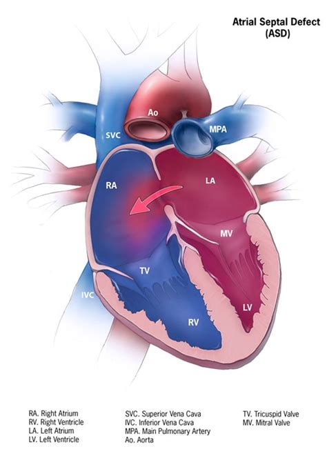 Ventricular Septal Defect Types