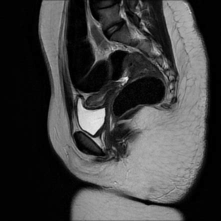 Hypoplastic uterus | Image | Radiopaedia.org