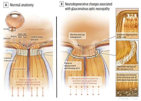 Figure 12. [(A) The optic nerve head...]. - Webvision - NCBI Bookshelf