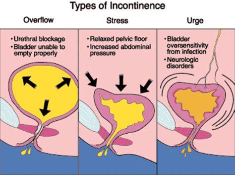 Incontinence – Bladder Leakage Causes, Looming Types & Proven Treatment ...