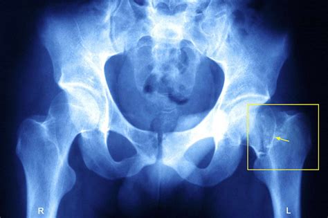 Hip Fracture Types and Complications