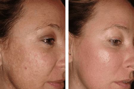 Learn About Laser Resurfacing for Acne Scars: Essence Medispa: Cosmetic ...