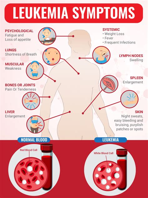 Leukemia Children Symptoms