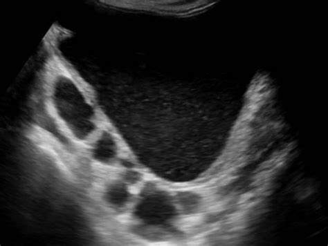 Urinary Tract and male reproductive system | 2.2 Bladder : Case 2.2.3 ...