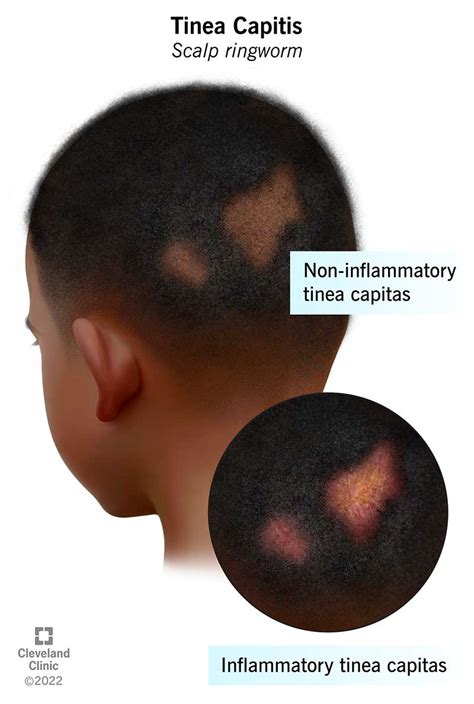 Tinea Capitis: Symptoms, Causes & Treatment