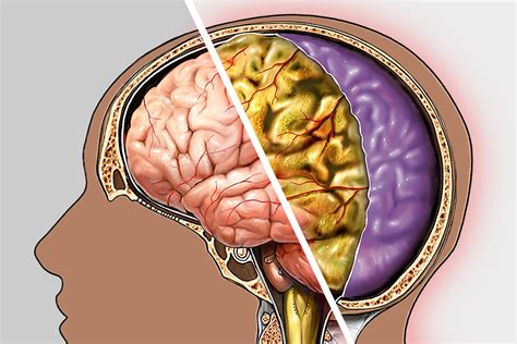 Meningitis Diagnosis and Treatment in Thailand - Almurshidi Medical ...