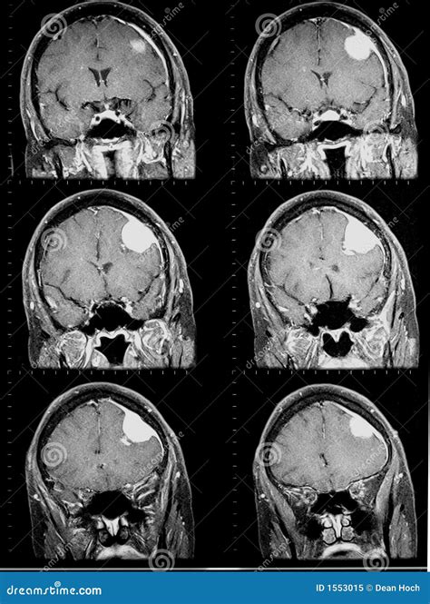 Mri of Brain Showing Brain Tumor Stock Image - Image of diagnostic ...