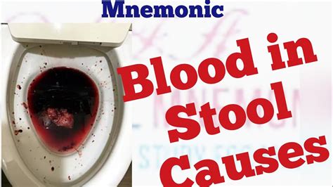 Causes of blood in stool Mnemonic - YouTube