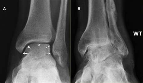 Ankle Arthritis (Swollen Ankle Joint) | The London Foot & Ankle Clinic