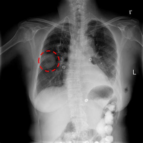 NIH releases 100K chest X-ray images for deep learning - Offtopic ...