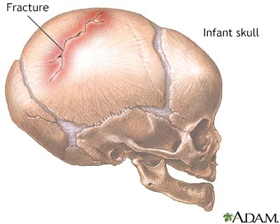 Skull fracture Information | Mount Sinai - New York