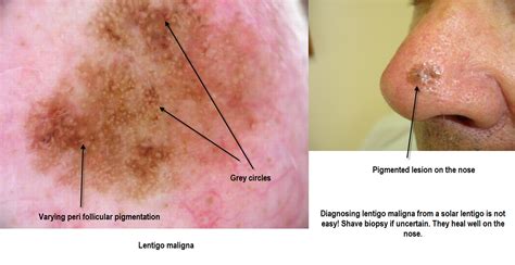 Dermoscopy Made Simple: Lentigo maligna