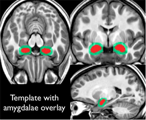 Amygdala Mri Sagittal