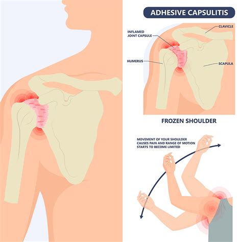 Key Insights About Frozen Shoulder in 2024 | Vejthani