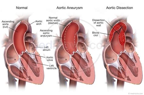 Image Gallery Dissection Aortic