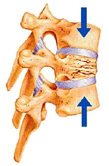 Thoracic Compression Fracture (2022)