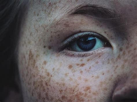 Freckles and Solar Lentigos - Stratum Clinics