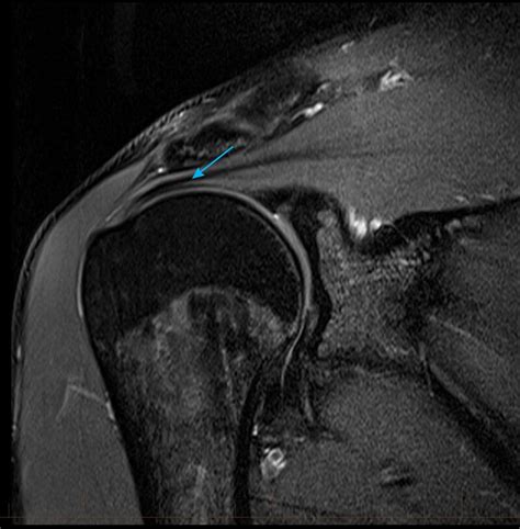 MRI Shoulder - Musculoskeletal Imaging