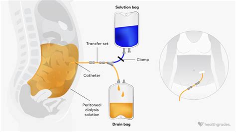 Peritoneal Dialysis: Preparation, Procedure, and Results