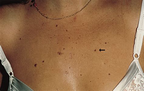 A 10-Year-Old In Situ Melanoma? | Dermatology | JAMA Dermatology | JAMA ...