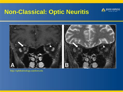 Paraneoplastic Neurological Disorders: What You Need to Know