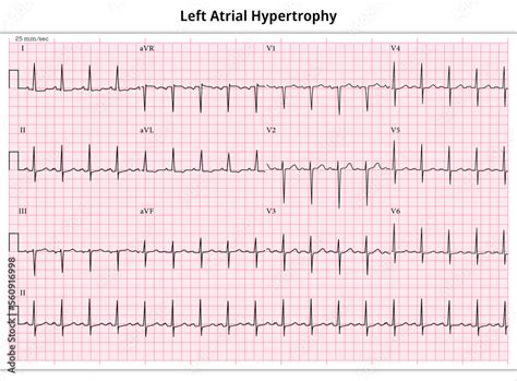 ECG Left Atrial Hypertrophy (LAH) - Left Atrial Enlargement (LAE) - 12 ...