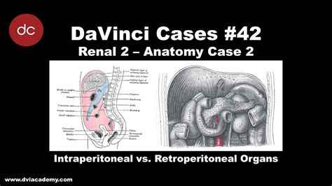 Intraperitoneal vs Retroperitoneal Hemorrhage [#DaVinciCases Renal 2 ...