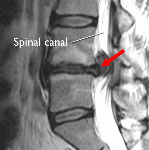 Mri Of Herniated Disc In Lower Back | Hot Sex Picture