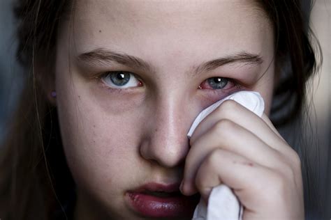 Viral Pink Eye: Symptoms, Treatment, and Prevention - eyeSTYLE blog ...