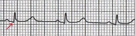 Q Wave • LITFL • ECG Library Basics