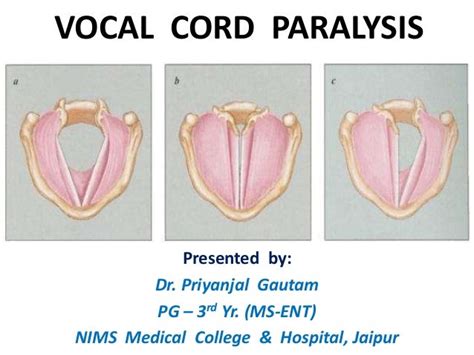 Vocal cord paralysis