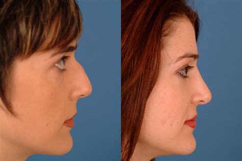 NASAL-SURGERY-4 – Dallas Advanced Facial Plastic Surgery Center