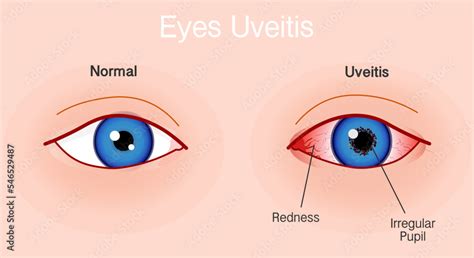 Uveitis eye anterior anatomy. Irritation, swelling, red infection ...