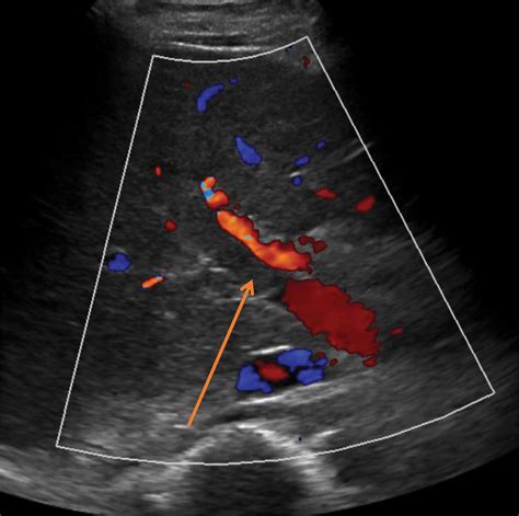 Update on Management of Portal Vein Thrombosis and the Role of Novel ...