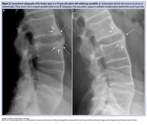 t spine lateral x ray ankylosing spondylitis - Google Search | Health ...